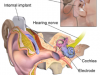 Cochlear Implants