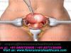 Latest Techniques Used in Hysterectomy Surgery in India