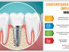 Rising Volume of Dental Implant Surgeries Fueling Osseointegration Implant Use