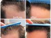 Know more about hair loss treatments   
