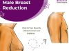 Best Gynecomastia Surgery in Hyderabad Hyderabad Plastic Surgery | Gynecomastia Enlarged breasts in 