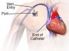 Totally Implantable Access Port Market: Fastest Growth, Demand and Forecast Analysis Report upto 202