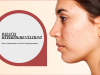 What You Should Know About Hyperpigmentation?