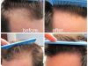 Treatment Procedures for Hair Transplant    