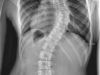 My Thoughts,feeling,and Scoliosis