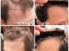 Important Aspects of Hair Transplant for Men and Women  