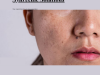 How to Reduce Skin Pigmentation with Ayurvedic Solutions?