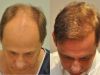 Hair Transplant Market Size, Key Players, Industry Growth Analysis and Forecast to 2027