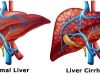 Best Liver Cirrhosis Treatment in Kochi India