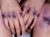 bruised knuckles (originally written on 11/21/16)