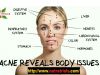 Acne Causes And Treatment Options To Know