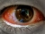 Traumatized Eyes