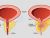 Global Benign Prostatic Hyperplasia (BPH) And Prostate Treatment Market: Detailed Analysis by Latest