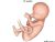 "Fetal Dwarfism"