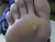 the wart
