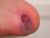 The Blister