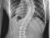 My Scoliosis Story.